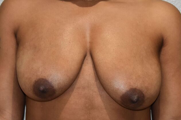 Breast Lift (Mastopexy) Case 193 - Before
