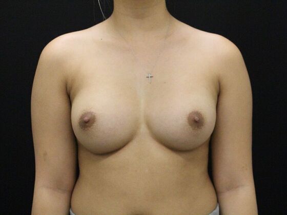 Breast Augmentation Case 95 - After