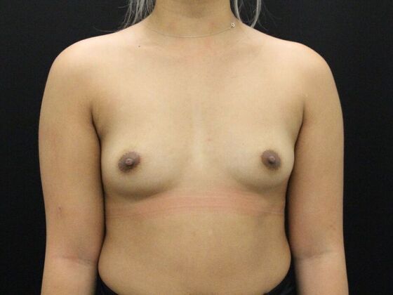 Breast Augmentation Case 95 - Before