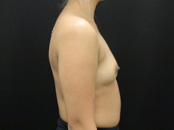 Breast Augmentation: Case 95 - Before