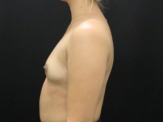 Breast Augmentation: Case 95 - Before
