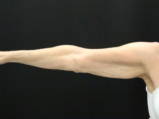 Arm Lift: Case 22 - Before