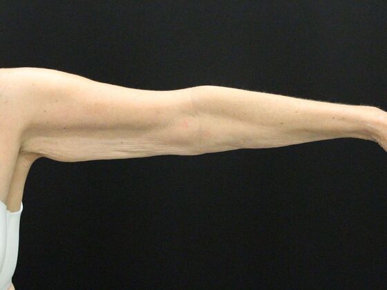 Arm Lift: Case 22 - Before