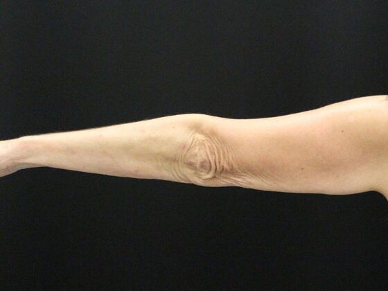 Arm Lift: Case 22 - Before