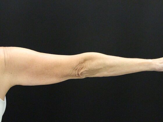 Arm Lift: Case 22 - Before