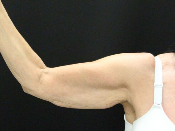 Arm Lift: Case 22 - Before