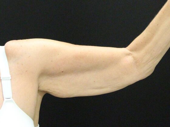Arm Lift: Case 22 - Before