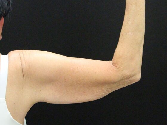 Arm Lift: Case 22 - Before