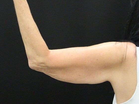 Arm Lift: Case 22 - Before