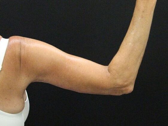 Arm Lift: Case 22 - After