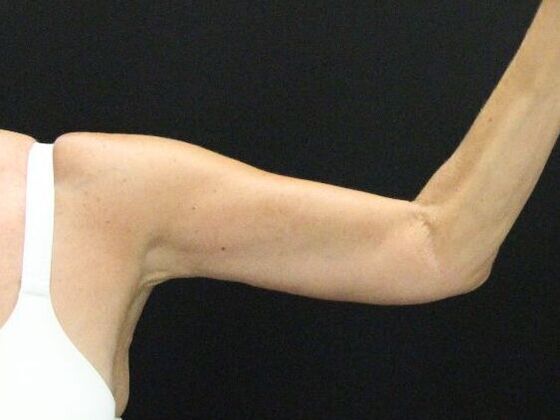 Arm Lift: Case 22 - After