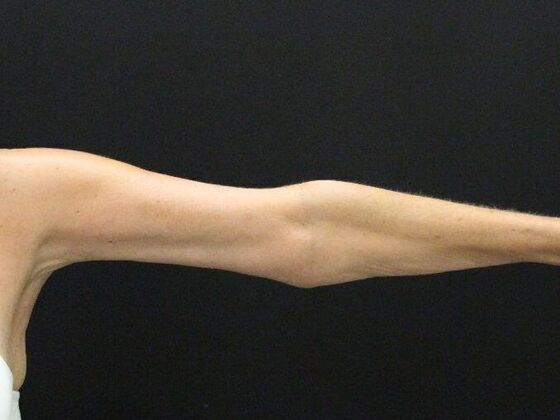 Arm Lift: Case 22 - After