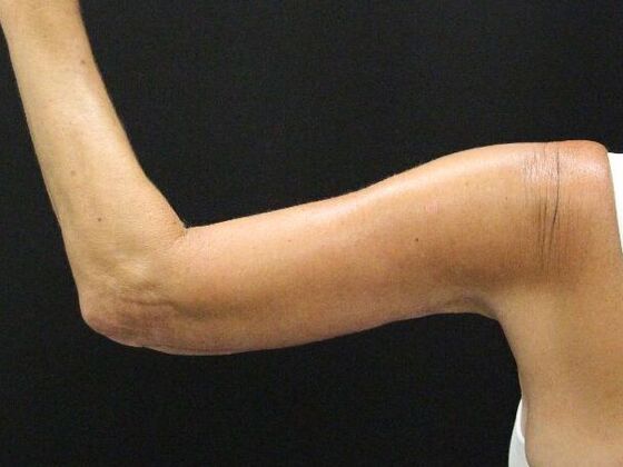 Arm Lift: Case 22 - After