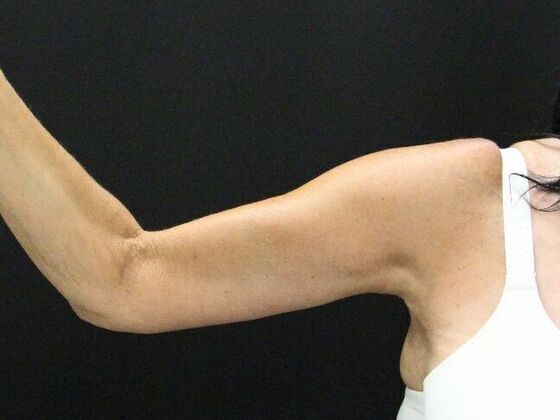 Arm Lift: Case 22 - Before