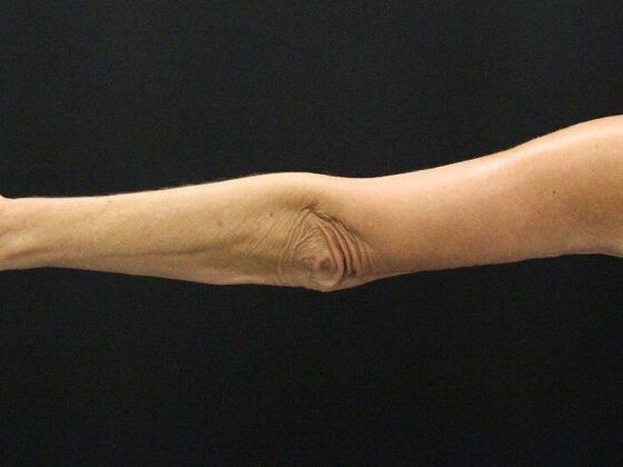 Arm Lift: Case 22 - After