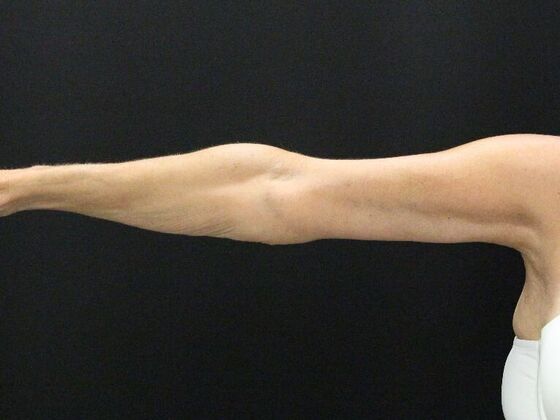 Arm Lift: Case 22 - After