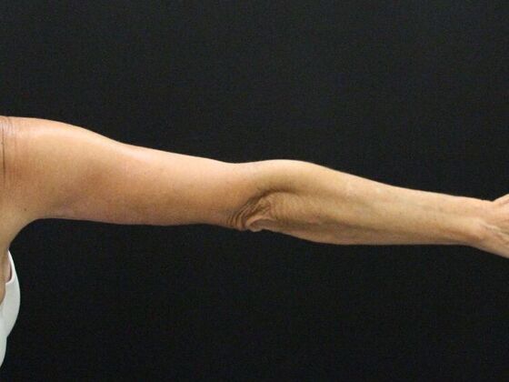 Arm Lift: Case 22 - After