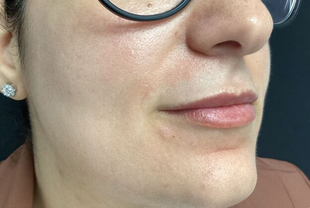 Mole Removal  Case 1 - After