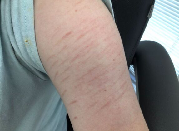 Scarring Scar treatment  - Before