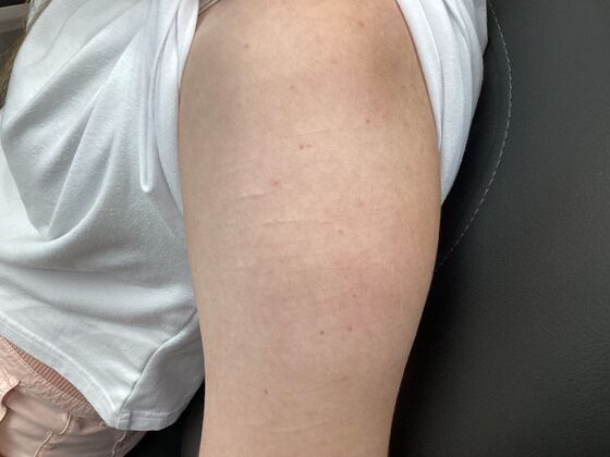 Scarring Scar treatment  - After