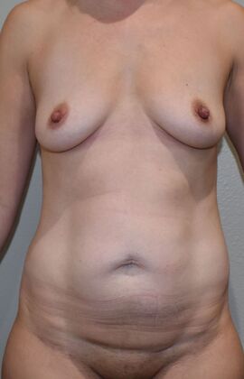 Mommy Makeover Case 296 - Before