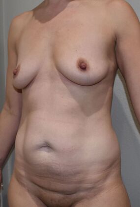 Mommy Makeover: Case 296 - Before