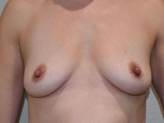 Breast Augmentation Case 754 - Before