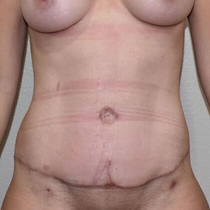 Tummy Tuck (Abdominoplasty): Case 463 - After
