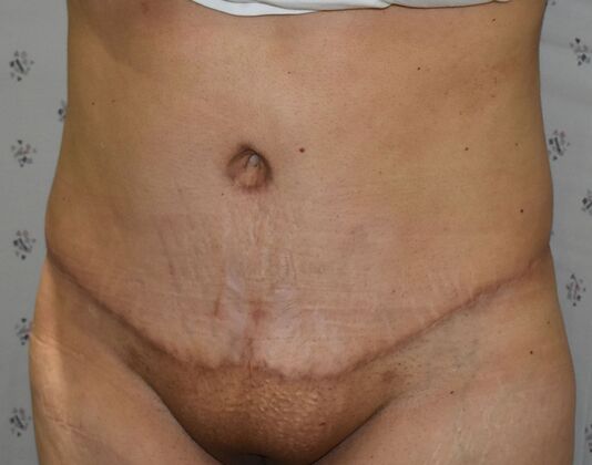 Tummy Tuck (Abdominoplasty): Case 464 - After