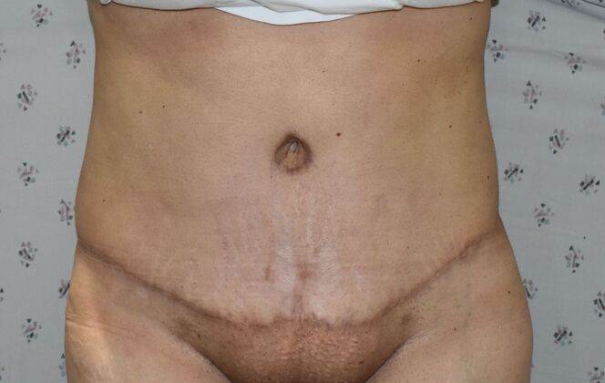 Tummy Tuck (Abdominoplasty): Case 464 - After