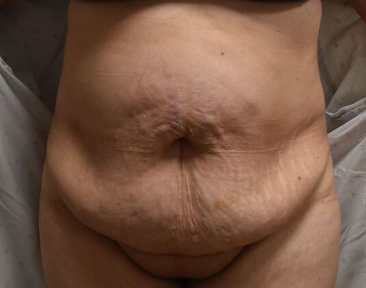 Tummy Tuck (Abdominoplasty): Case 464 - Before