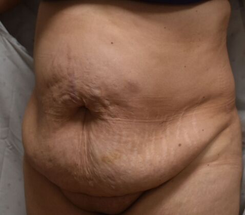Tummy Tuck (Abdominoplasty): Case 464 - Before