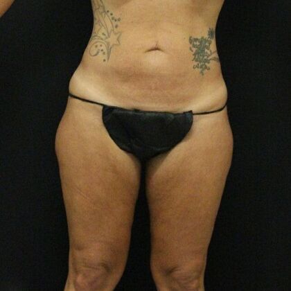 Thigh Lift: Case 7 - Before