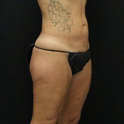 Thigh Lift: Case 7 - Before