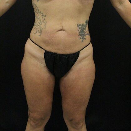 Thigh Lift: Case 7 - After
