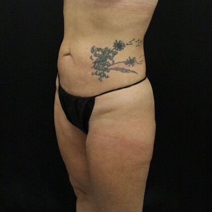 Thigh Lift: Case 7 - After