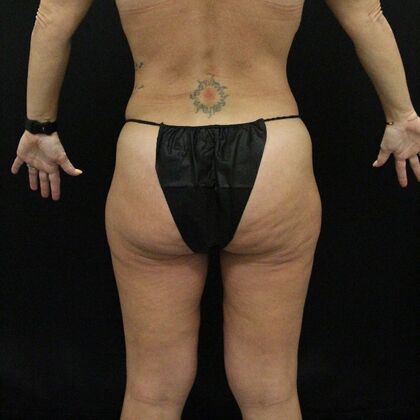 Thigh Lift Case 7 - After