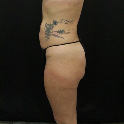 Thigh Lift: Case 7 - After