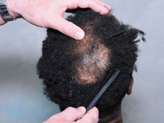 FUT Hair Restoration: Case 38 - Before