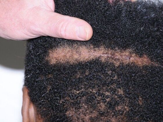 FUT Hair Restoration: Case 38 - After