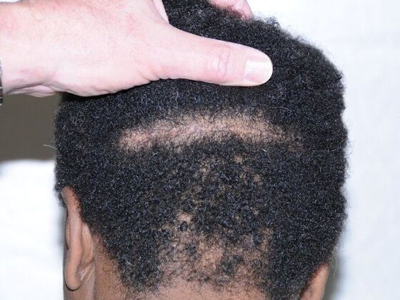 FUT Hair Restoration: Case 38 - After