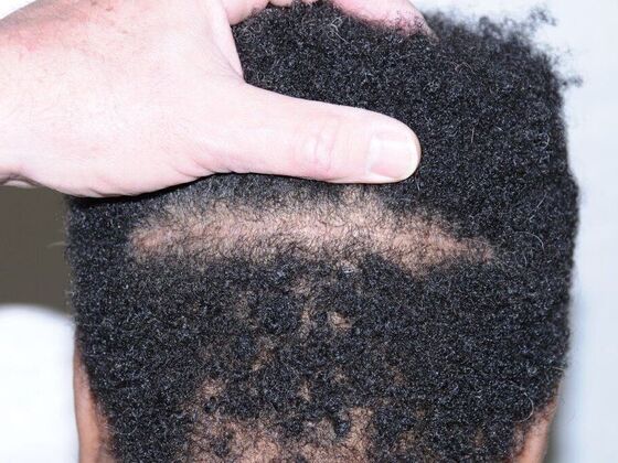 FUT Hair Restoration: Case 38 - After