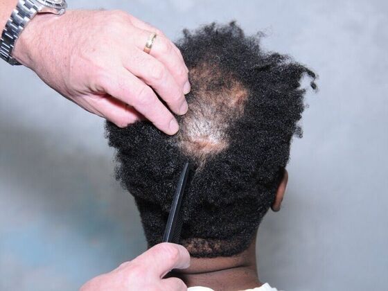 FUT Hair Restoration: Case 38 - Before