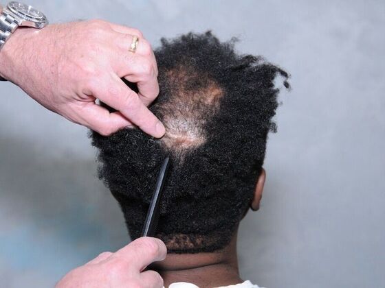 FUT Hair Restoration: Case 38 - Before