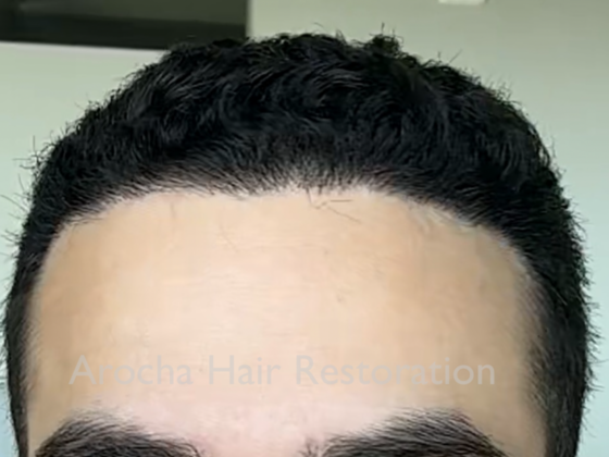 FUE Hair Restoration: Case 33 - Before