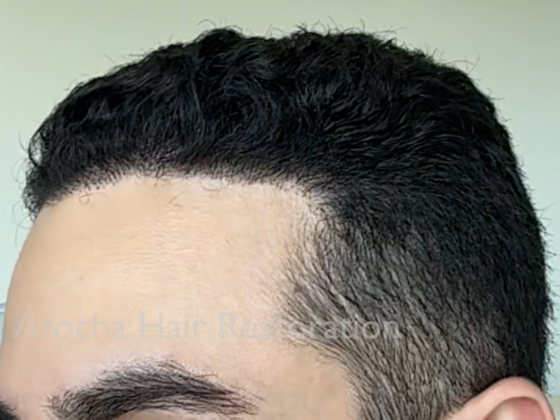 FUE Hair Restoration: Case 33 - After