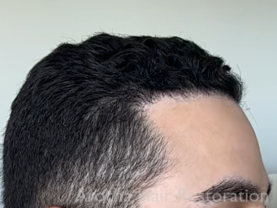 FUE Hair Restoration: Case 33 - After