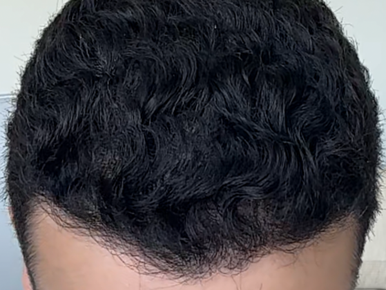 FUE Hair Restoration: Case 33 - After