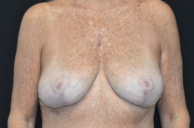 Mastopexy Case 4 - After