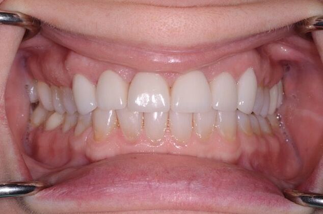 Dental Crowns: Case 2 - After